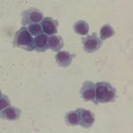 Leukemia STEM cells now targeted.